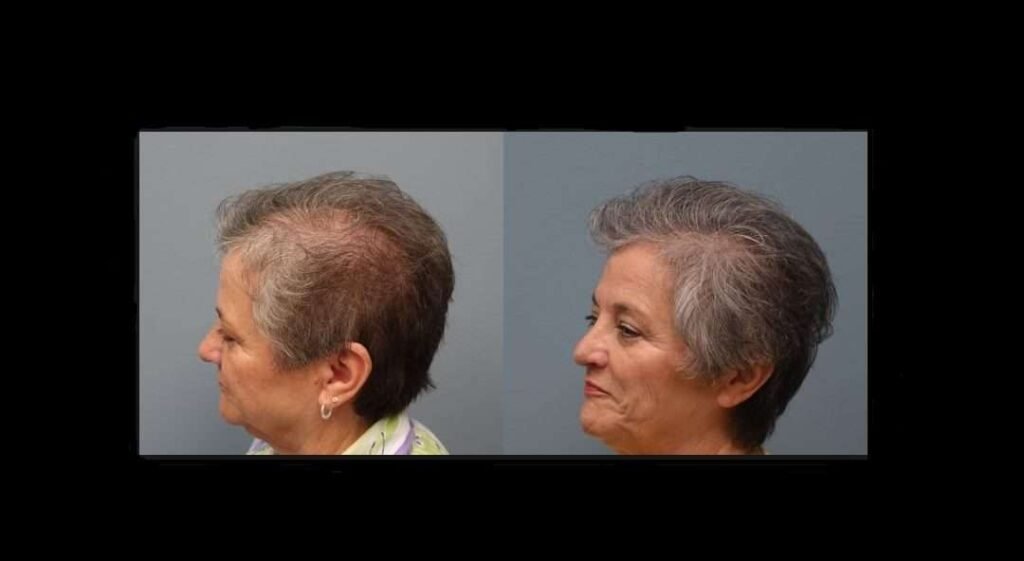 Side-profile before and after photographs of a Beyond Stem Cells hair restoration patient showing increased coverage across the crown
