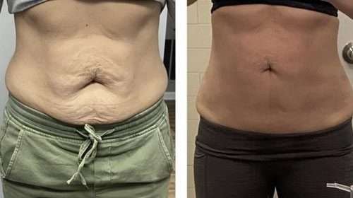 cryoskin-therapy (2)