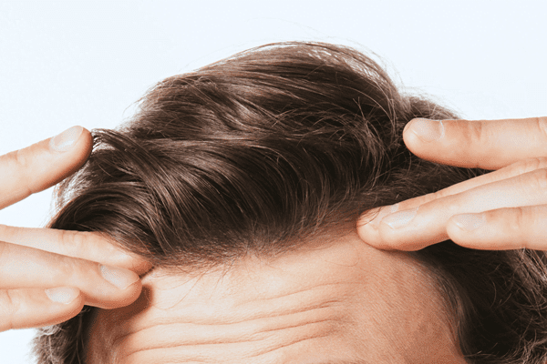 hair-restoration-for-men