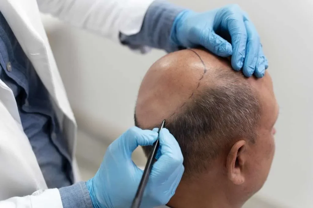 Hair-Loss-Consultation-Reclaiming-Your-Crowning-Glory