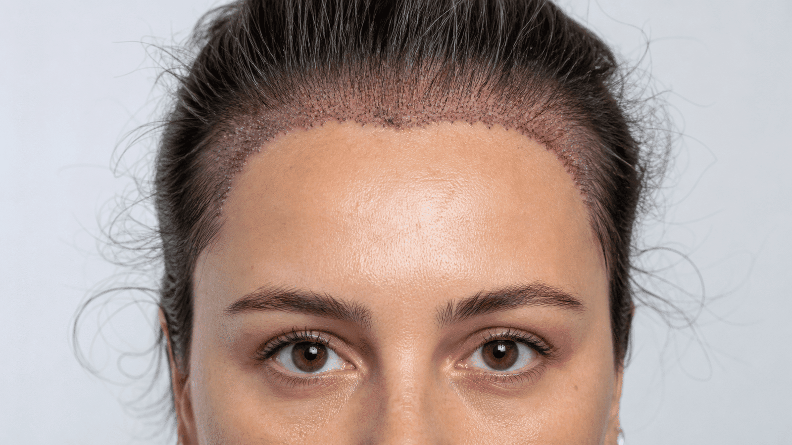 Ultra-realistic close-up of a female patient after a frontal hair transplant procedure showing newly implanted follicular grafts along the frontal hairline and temples in a clinical setting.