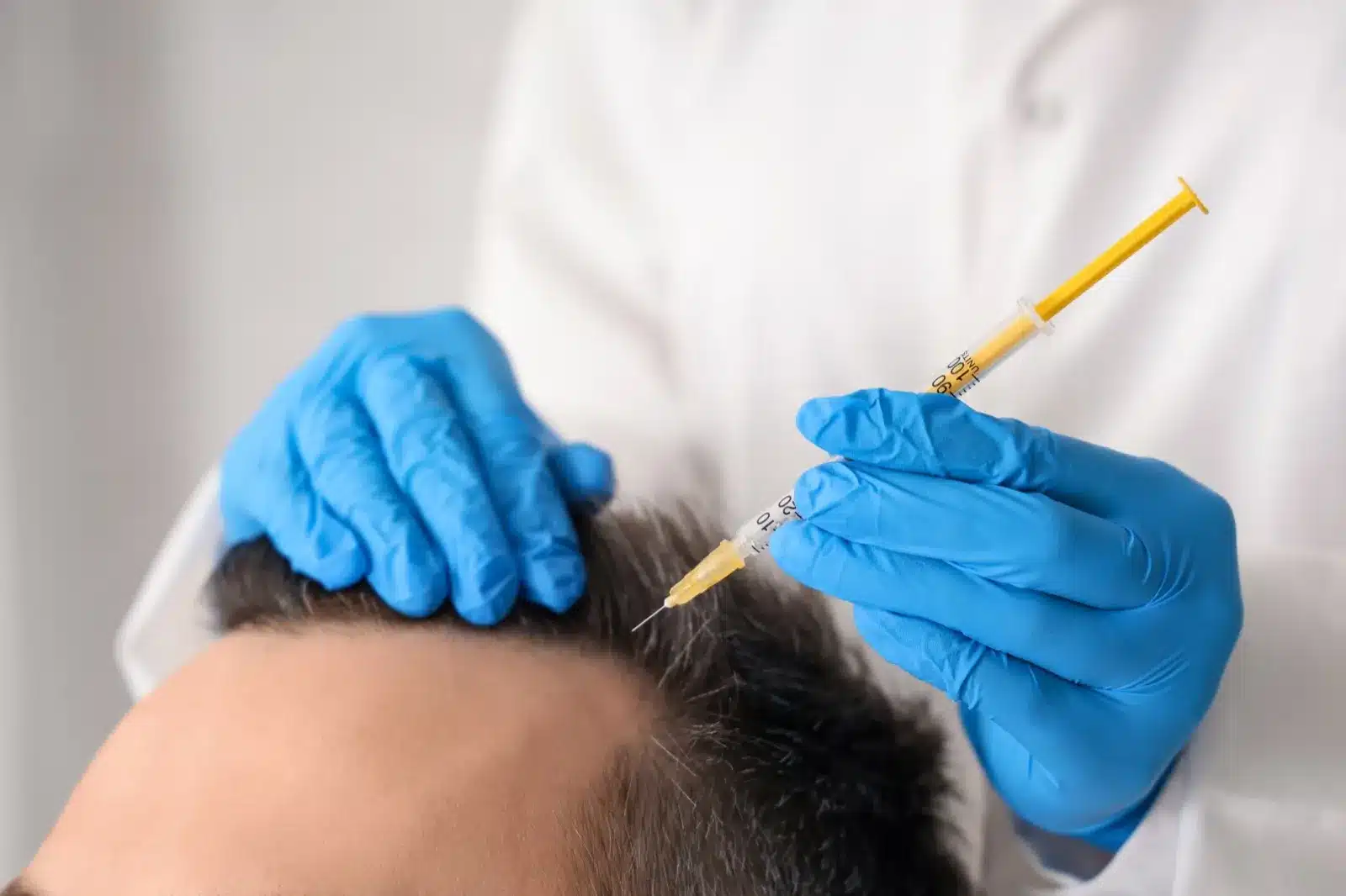 Non-surgical stem cell hair restoration scalp treatment at Beyond Stem Cells