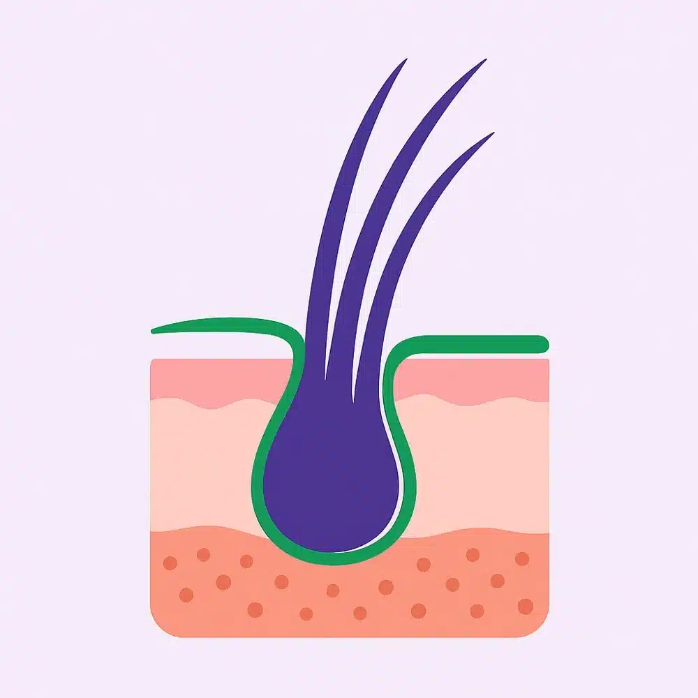 Illustration of a single hair graft: a follicular unit with three hair shafts and roots shown in a cutaway of the scalp layers
